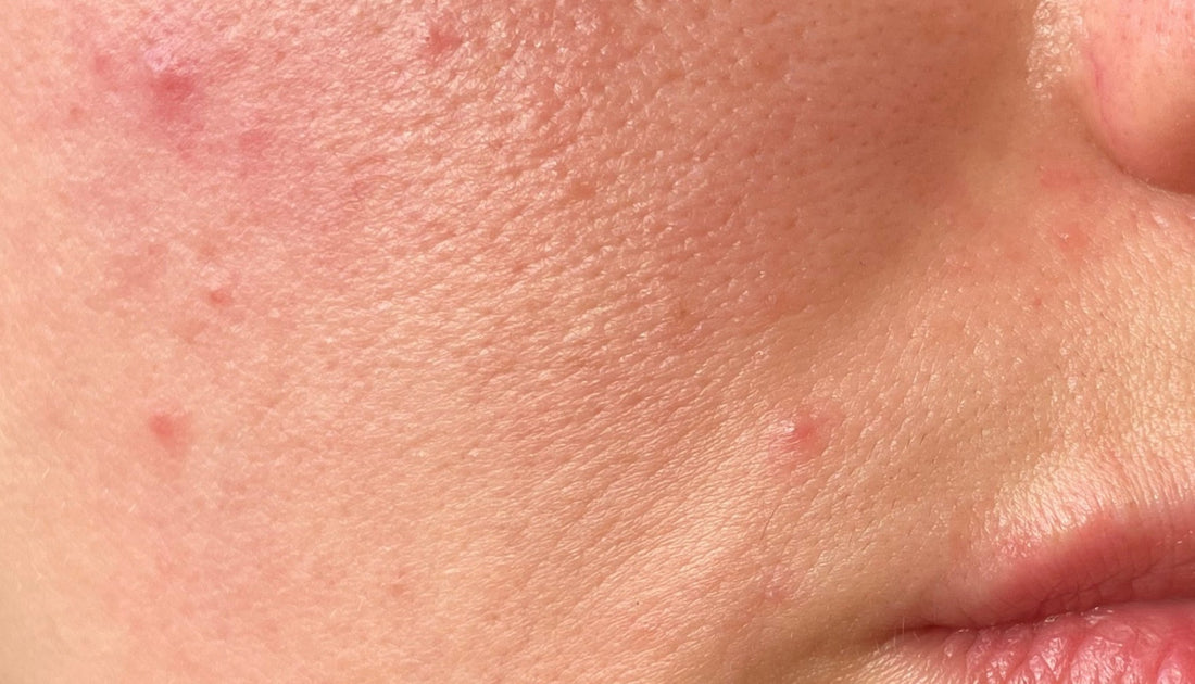 Acne & Blemish-Prone Skin