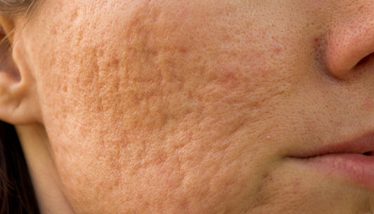 Scars & Acne Scarring
