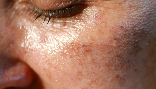 Hyperpigmentation & Pigmentation Concerns