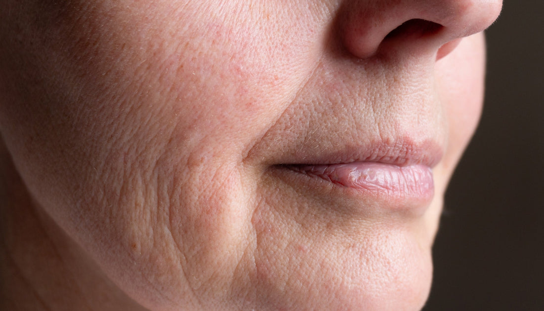 Skin Laxity & Loss of Firmness