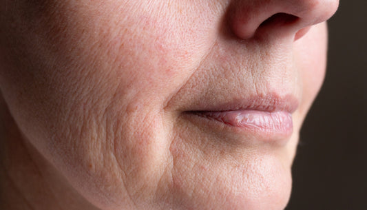 Skin Laxity & Loss of Firmness