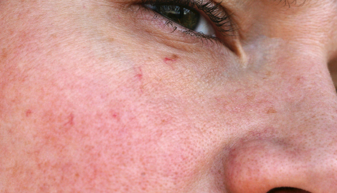 Rosacea-Prone Skin