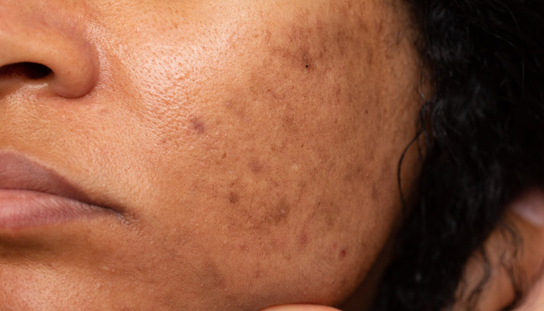 Sun-Damaged Skin & Photoageing