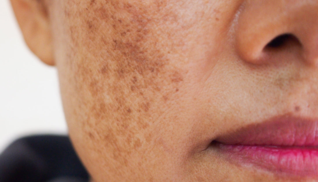 Uneven Skin Tone & Discolouration