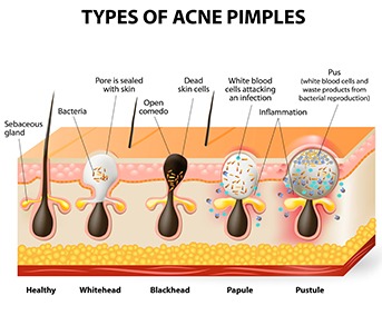 What Causes Acne?