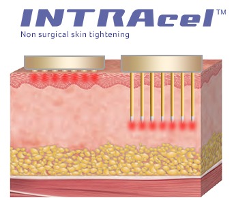 INTRAcel Treatment
