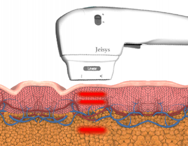 ULTRAcel Q+ Treatment