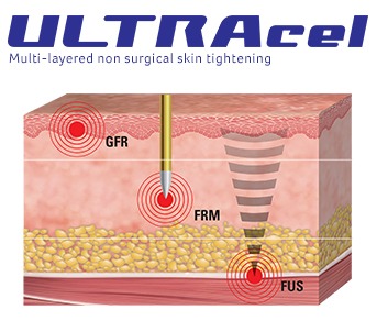 ULTRAcel Treatment