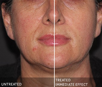 How does ULTRAcel work?