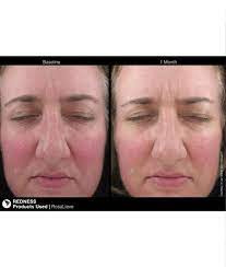 Rosacea treatment