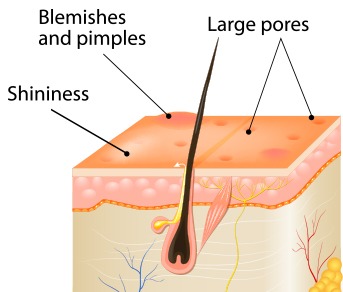 What Causes Oily and Greasy Skin?